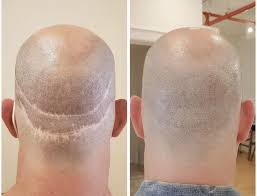 What aftercare is needed for a hair transplant in Istanbul?
