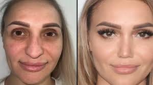 Is plastic surgery turkey covered by insurance?